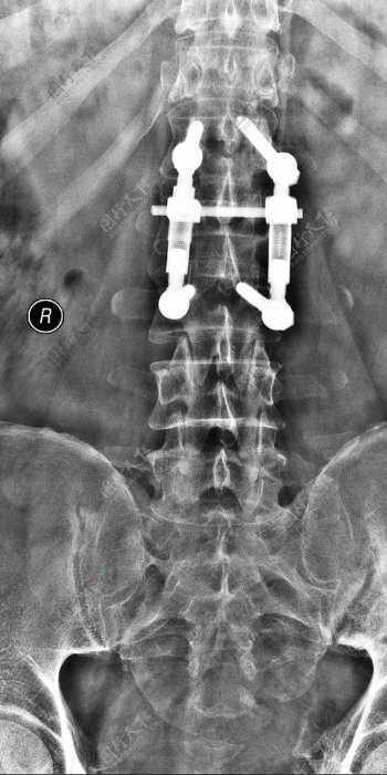 X线照片腰椎图片