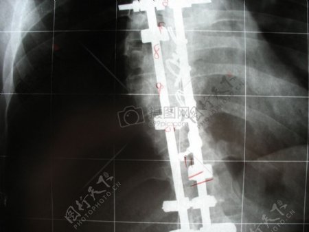 人体的脊椎图片