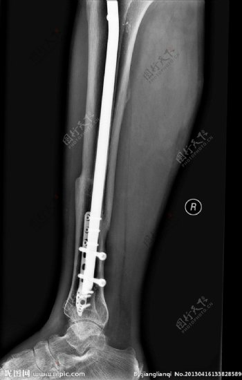X线拍片踝关节图片