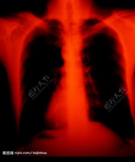 胸腔X光图片