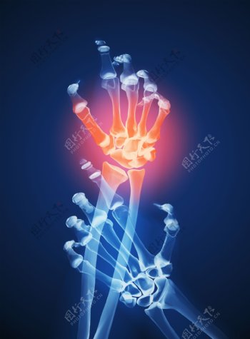 人体手腕X光透视图图片